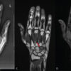 Osteoblastoma of the Hamate: A Case Report