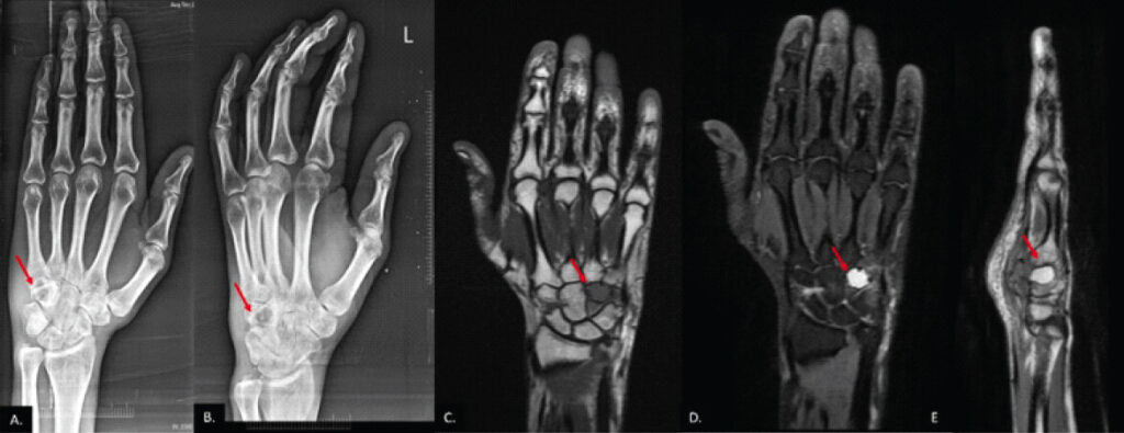 Figure 1: X-ray of the hand shows (a) anteroposterior and (b) oblique views showing a lytic lesion in the hamate (red arrow). Magnetic resonance imaging shows (c) a coronal T1-weighted image showing a hypointense lesion in the hamate (red arrow), (d) a coronal fat-saturated T2-weighted sequence showing a hyperintense lesion in the hamate (red arrow), and (e) a sagittal T2-weighted image showing blood fluid levels in the lesion (red arrow).