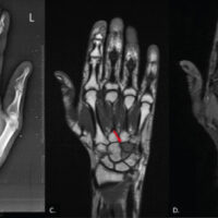 Figure 1: X-ray of the hand shows (a) anteroposterior and (b) oblique views showing a lytic lesion in the hamate (red arrow). Magnetic resonance imaging shows (c) a coronal T1-weighted image showing a hypointense lesion in the hamate (red arrow), (d) a coronal fat-saturated T2-weighted sequence showing a hyperintense lesion in the hamate (red arrow), and (e) a sagittal T2-weighted image showing blood fluid levels in the lesion (red arrow).