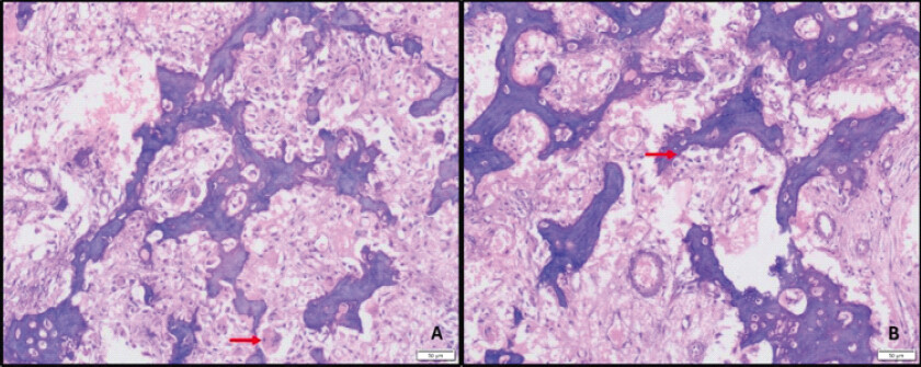 Figure 2: Histopathology demonstrates (a) inter-anastomosing trabeculae of woven bone in a loose edematous fibrovascular stroma. Occasional osteoclast-type multinucleated giant cells are present (red arrow) (hematoxylin and eosin, ×100), (b) bony trabeculae lined by osteoblasts (red arrow) (hematoxylin and eosin, ×100).
