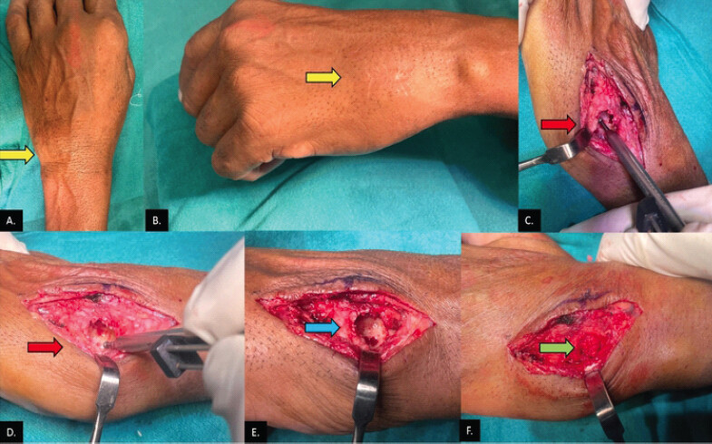 Figure 3: Clinical images show (a and b) swelling in the wrist (black arrows). (c and d) Intraoperative pictures show extended curettage with high-speed burr, (e) shows a post-curettage void, and (f) shows a compactly filled void with autologous cancellous graft.