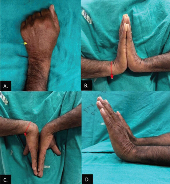 Figure 4: Shows (a) clenched fist showing healed dorsal incision scar (yellow arrow), (b and d) equal full wrist extension on both sides, and (c) comparable wrist flexion on both sides.