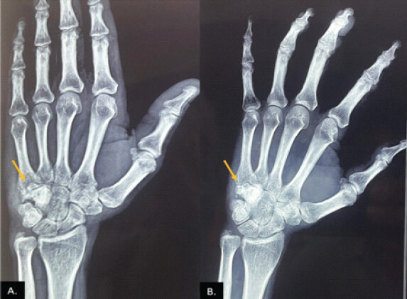 Figure 5: Post-operative radiograph shows dense hamate with bone graft within.