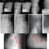 A Study of Spinopelvic Relationship and its Impact on Functional Outcome of Total Hip Arthroplasty