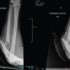 Management of a Nonunion Type IIC Monteggia Fracture