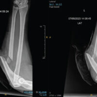 Figure 1: Anteroposterior (left) and lateral (right) on initial presentation to emergency department.