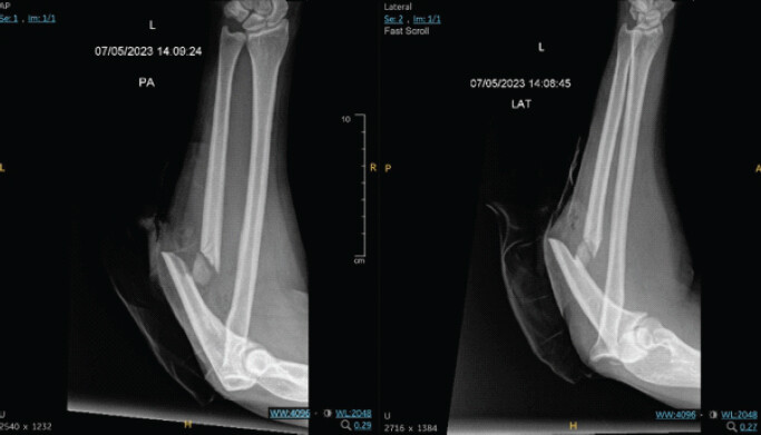 Figure 1: Anteroposterior (left) and lateral (right) on initial presentation to emergency department.