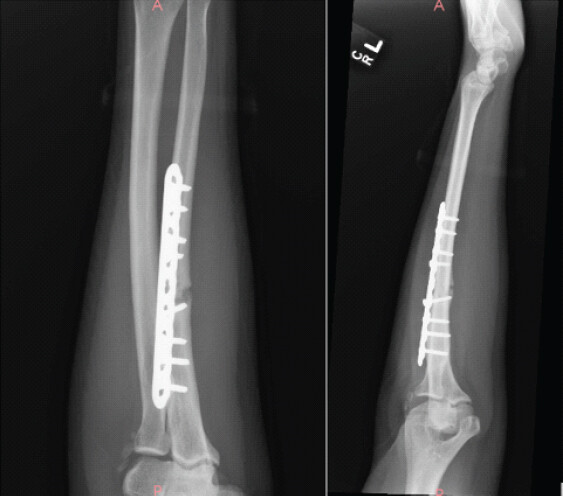 Figure 2: Anteroposterior (left) and Lateral (right) after initial surgery.