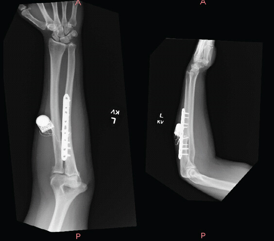 Figure 3: Anteroposterior (left) and Lateral (right) after second surgery.