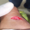 Open Traumatic Achilles tendon Rupture in a Pediatric Patient Managed by Modified Kessler Technique: A Case Report