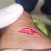 Figure 1: Pre-operative posterior ankle laceration showing exposed Achilles tendon ends.