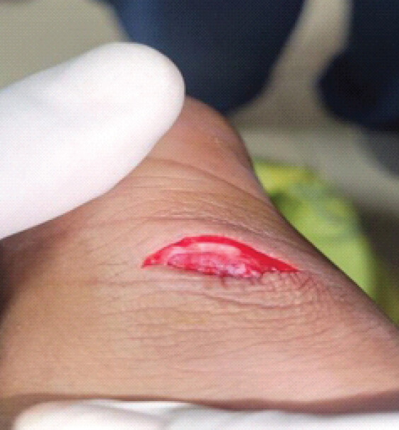 Figure 1: Pre-operative posterior ankle laceration showing exposed Achilles tendon ends.
