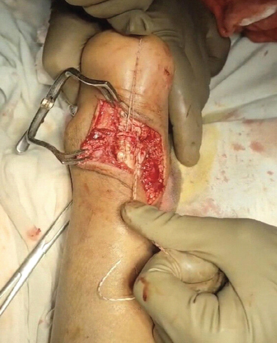 Figure 2: Intraoperative image demonstrating modified Kessler suture placement.
