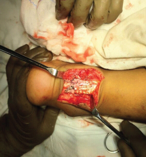 Figure 3: Intraoperative image demonstrating complete repair with epitendinous augmentation suture.