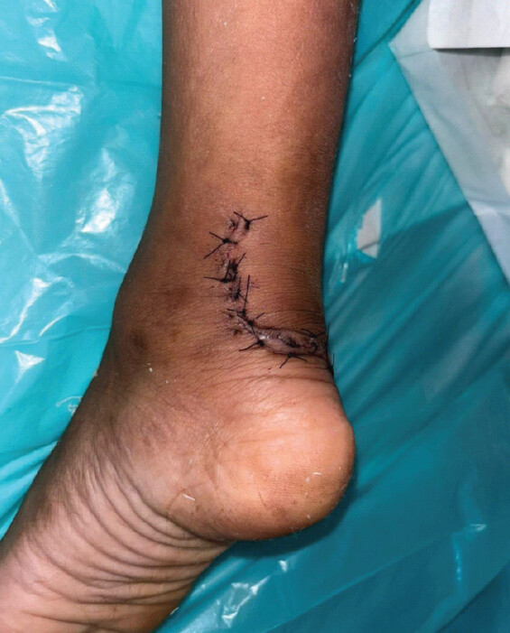 Figure 4: Clinical photograph at 2-week follow-up showing healed wound and active plantar flexion.
