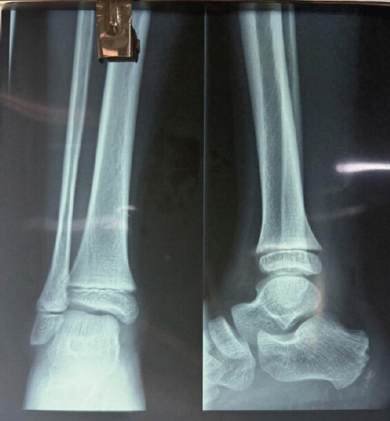 Figure 5: Plain radiograph demonstrating no bony deformities.