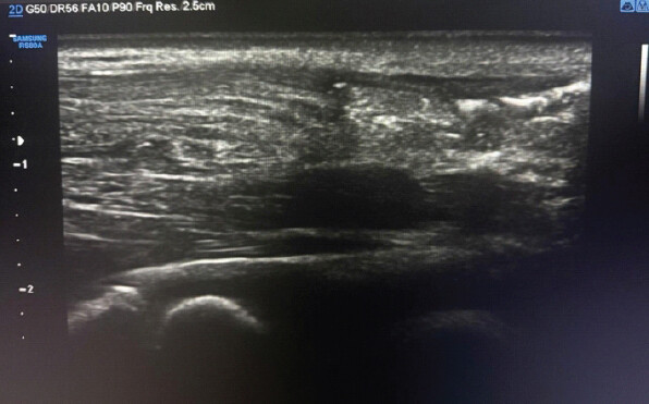 Figure 6: Ultrasonography demonstrated complete discontinuity of Achilles tendon fibers approximately 4.5 cm proximal to calcaneal insertion.