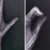 The Tiny Tumor with Disproportionate Pain: Subungual Glomus Tumor of the Thumb Managed with Nail-Sparing Excision: A Case Report