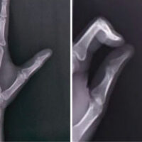 Figure 1: Pre-operative radiograph showing subtle cortical scalloping of distal phalanx.