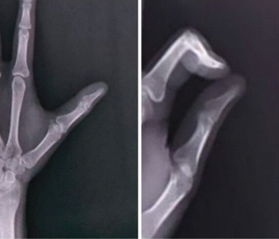Figure 1: Pre-operative radiograph showing subtle cortical scalloping of distal phalanx.