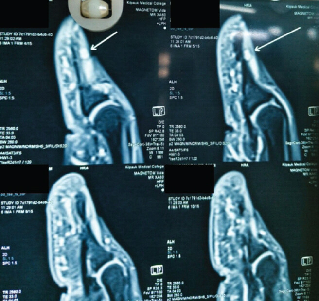 Figure 2: Magnetic resonance imaging demonstrating subungual lesion with T1 hypointensity and T2 hyperintensity.