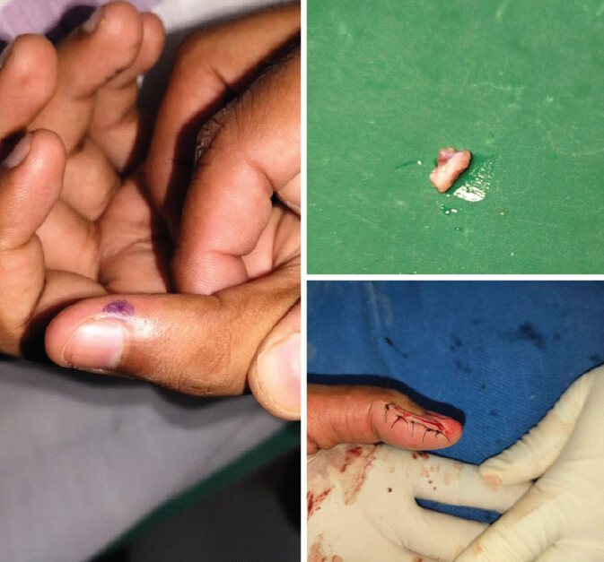 Figure 3: (a): Pre-operative marking of the point of maximum tenderness to center the incision over the tumor. (b) Intraoperative image showing excised tumor. (c) Intraoperative image showing nail-sparing paraungual approach after skin closure.