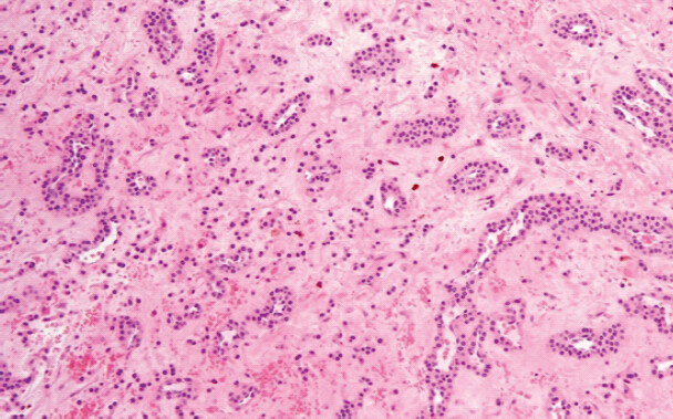 Figure 4: Histo-pathological examination of biopsy specimen showing nests of uniform round glomus cells surrounding vascular channels.