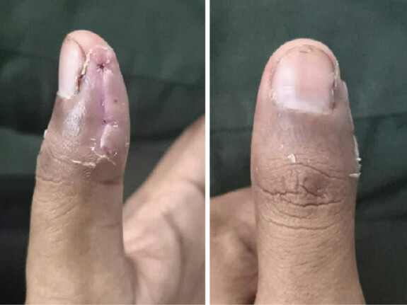 Figure 5: Clinical photograph demonstrating good scar healing and a normal looking nail at 3 months follow-up