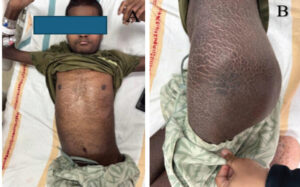 Figure 1: (a) Clinical photograph demonstrating generalized ichthyotic skin changes over the trunk. (b) Clinical photograph showing ichthyosis vulgaris over the left hip.