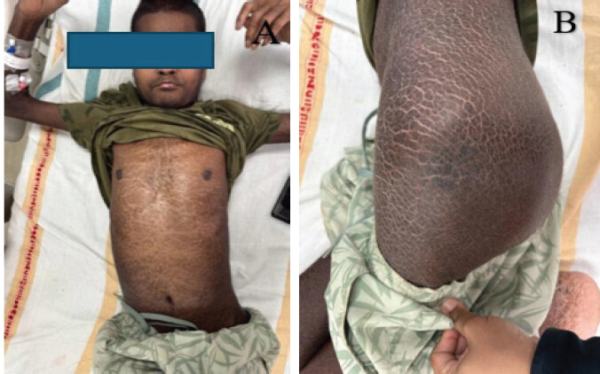 Figure 1: (a) Clinical photograph demonstrating generalized ichthyotic skin changes over the trunk. (b) Clinical photograph showing ichthyosis vulgaris over the left hip.