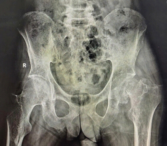 Figure 2: Radiographs of the pelvis and left hip, which demonstrated a displaced transcervical femoral neck fracture with features of non-union and early femoral head resorption.