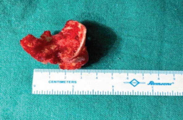 Figure 3: Intraoperative image showing a fragmented portion of the femoral head following piecemeal extraction, highlighting severe osteoporosis and structural fragility of bone.