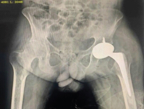 Figure 4: Post-operative radiographs demonstrated a well-positioned acetabular and femoral component.