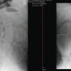 Direct Endoscopic Visualization of Gas Release in a Lumbar Disc Herniation: A Case Report