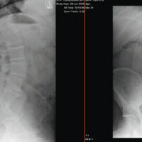 Figure 1: Anterior-posterior and lateral plain radiographs of the lumbar spine showing transitional lumbosacral morphology as well as advanced degenerative disc disease, particularly at the L5-1 segment.
