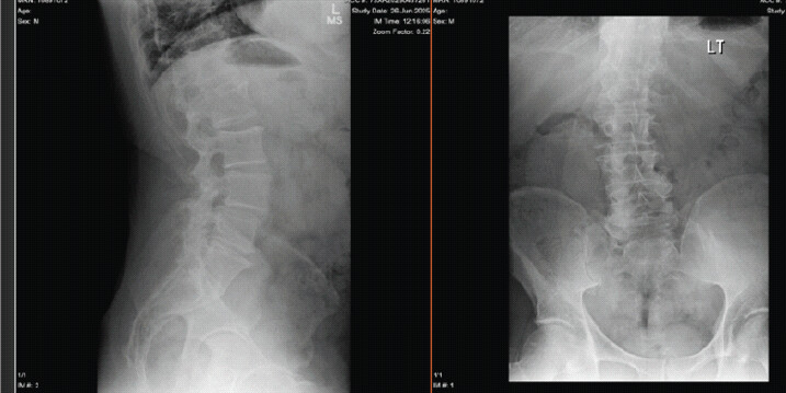 Figure 1: Anterior-posterior and lateral plain radiographs of the lumbar spine showing transitional lumbosacral morphology as well as advanced degenerative disc disease, particularly at the L5-1 segment.