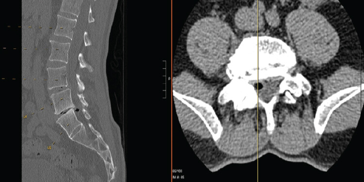 Figure 2: A lumbar computed tomography scan showing clearly the gas-filled diverticular-appearing disc herniation in the right lateral recess.