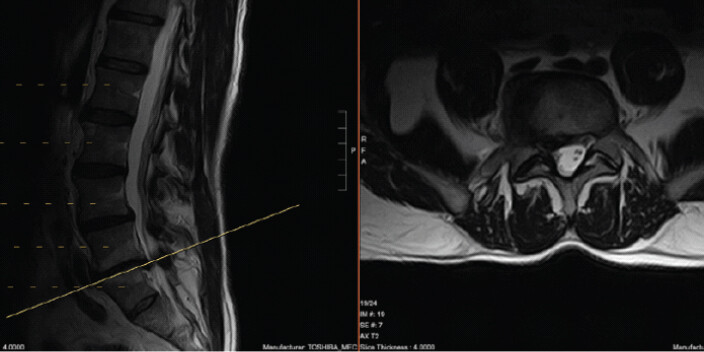 Figure 3: A T2-weighted magnetic resonance imaging scan again showing the disc herniation and compression of the descending nerve root at L5-1. Noticeably, this herniation is not clearly differentiated from a standard disc material-filled herniation.