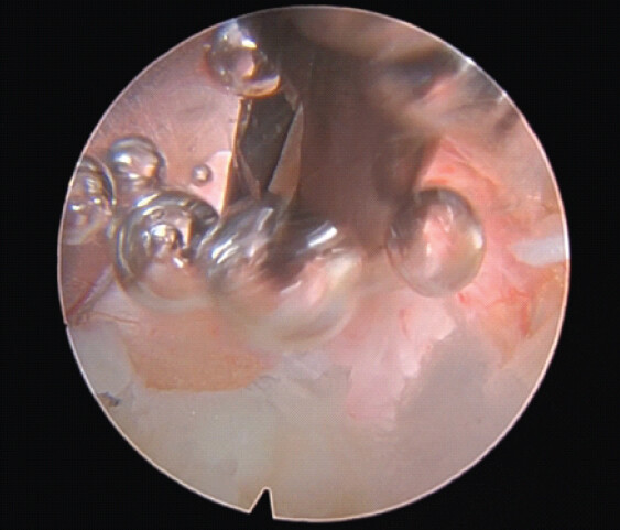 Figure 4: A micropituitary is shown biting into the discal diverticulum and the subsequent release of gas.