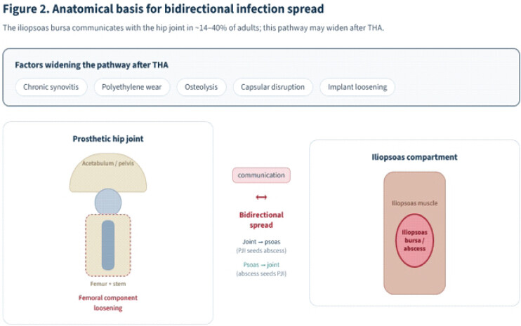 Figure 2: Conceptual schematic of the communication between the iliopsoas bursa and the hip joint, and the post-arthroplasty factors that favor bidirectional spread of infection.