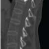 Indolent Systemic Mastocytosis Presenting with Consecutive Vertebral Fragility Fractures despite Normal Bone Mineral Density: A Case Report and Mechanistic Review