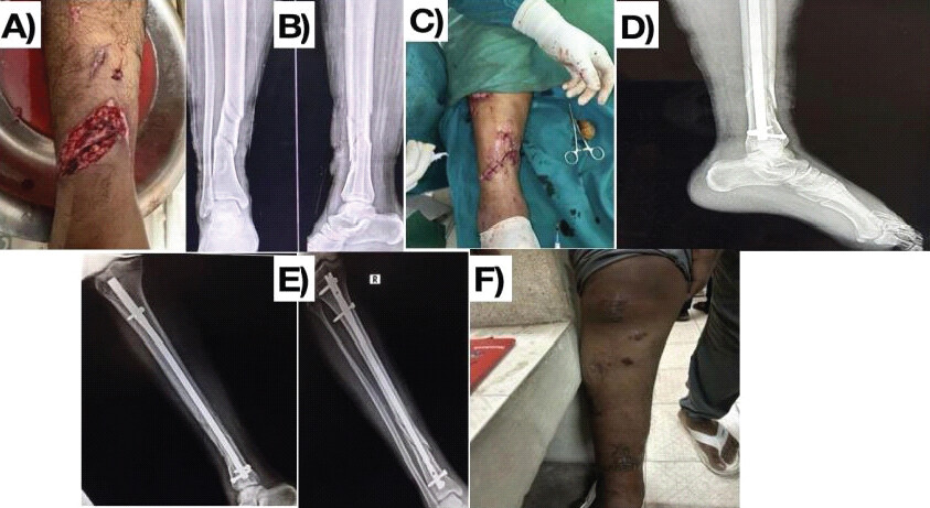 Figure 1: Representative case of compound fracture managed with primary definitive internal fixation within 72 h. (a) Wound before arrival, (b and c) pre-operative radiograph, (c) Wound following surgical debridement (~12 h after injury), (d) post-operative radiograph after definitive internal fixation (~24 h after debridement), and (e) follow-up radiograph at 2 months showing progressive fracture union; patient-identifying details have been cropped from the original image. (f) Clinical photograph at 2 months showing healed soft tissue.