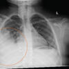 Askin Tumor Presents with Ewing Sarcoma of the Femur in Young Female Patient: Case Report and Literature Review