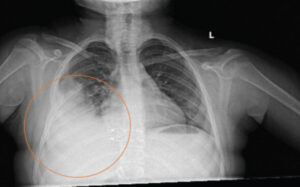 Figure 1: Chest radiograph showing a homogeneous radiopacity in the right lung.