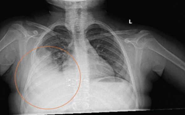Figure 1: Chest radiograph showing a homogeneous radiopacity in the right lung.