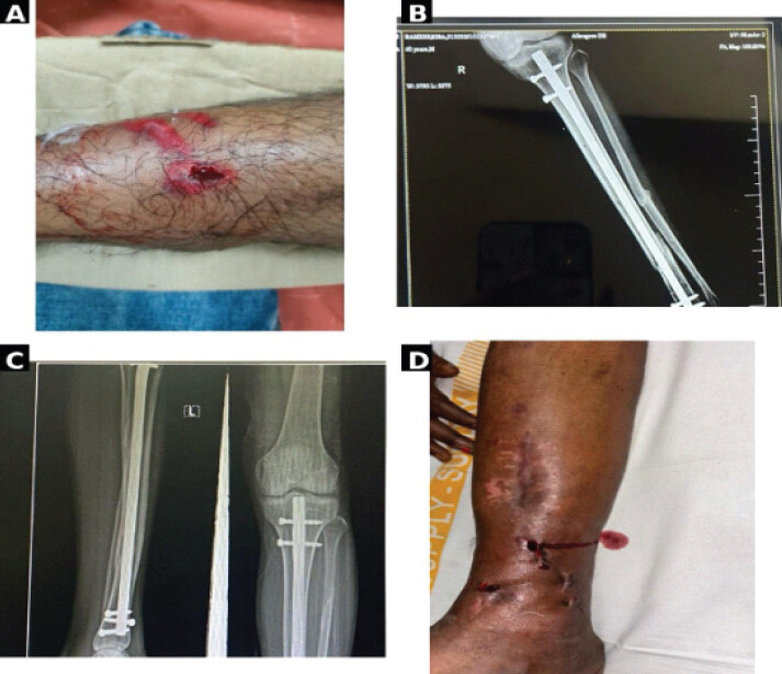 Figure 2: Second representative case illustrating fracture union following early definitive fixation. (a) Pre-operative wound. (b) Post-operative radiograph after definitive internal fixation; patient-identifying details have been cropped from the original image. (c) Follow-up radiograph showing a united fracture; patient-identifying details have been cropped from the original image. (d) Clinical photograph showing the healed wound after subsequent implant removal.