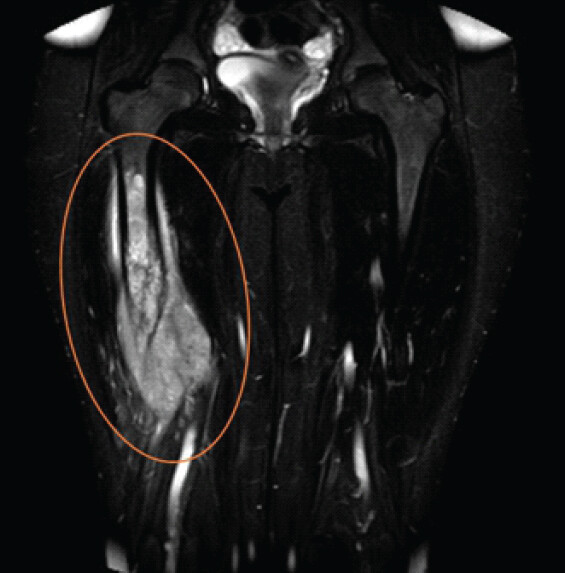 Figure 2: Magnetic resonance imaging of the thighs, revealing an aggressive right femoral bone malignancy.