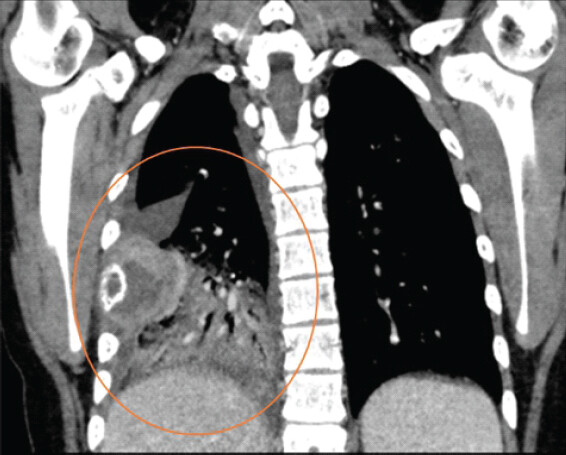 Figure 3: Computed tomography with contrast showing a heterogeneous mass in the right lung with a large soft-tissue component and pleural effusion.
