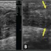 Opportunistic Biological Augmentation during Acute Achilles Tendon Repair: A Novel Surgical Concept With Three-Year Follow-Up—A Case Report