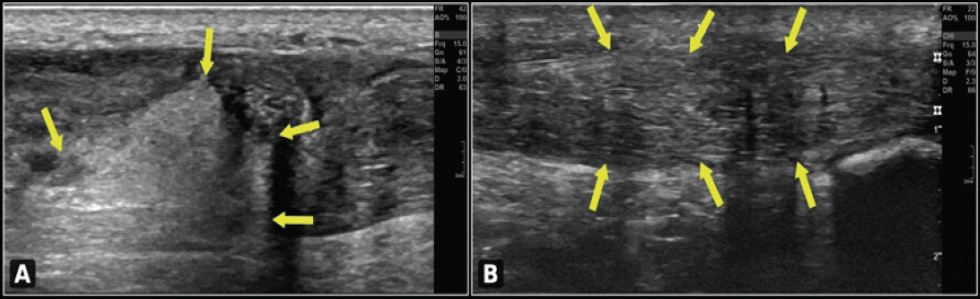 Figure 1: Ultrasound images of the right Achilles tendon: (a) pre-operative image demonstrating complete tendon rupture with loss of continuity and hypoechoic gap (yellow arrows indicate the rupture margins); (b) 3-year follow-up demonstrating restored tendon continuity with no evidence of re-rupture (yellow arrows delineate the intact repaired tendon).